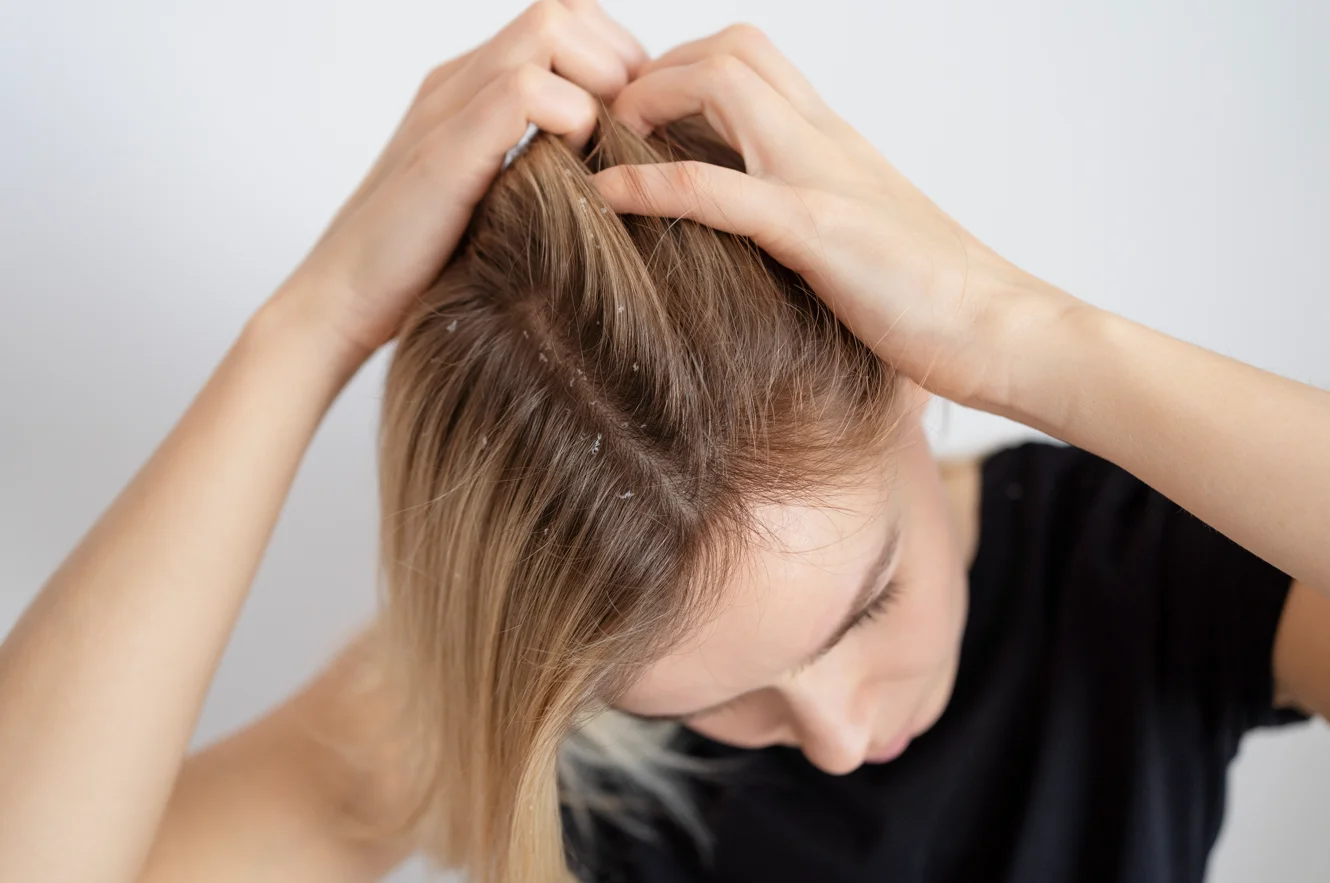 Does Dandruff Cause Hair Loss?