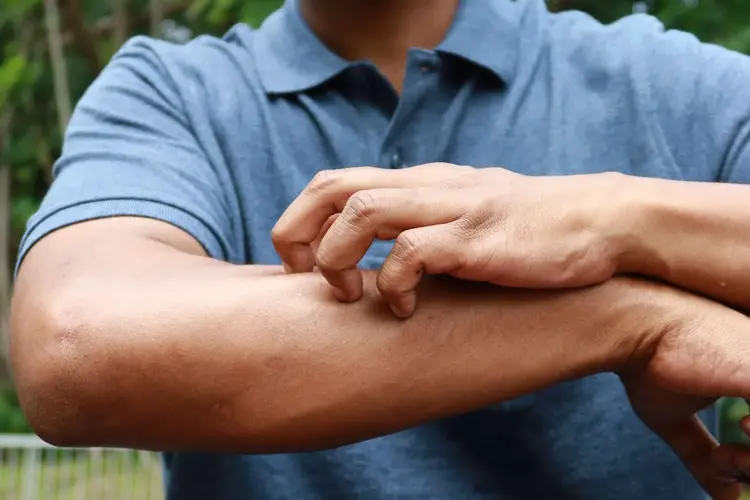 Groin/Sweat/ Fungal nail infections