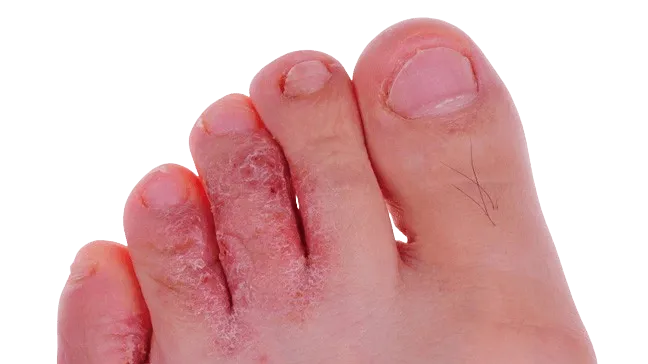Athlete’s foot