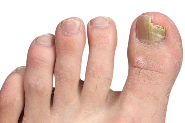 Nail Fungus Treatments